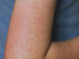 冬季热射病高发引警惕:泡温泉过长及运动穿着过厚